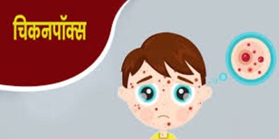 बाराबंकी: पीठापुर में फैला चिकनपॉक्स, 11 लोग चपेट में